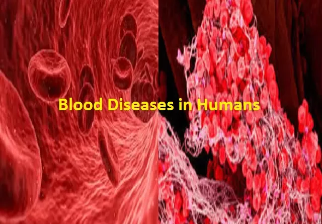 Blood Diseases